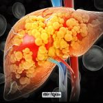 fatty liver